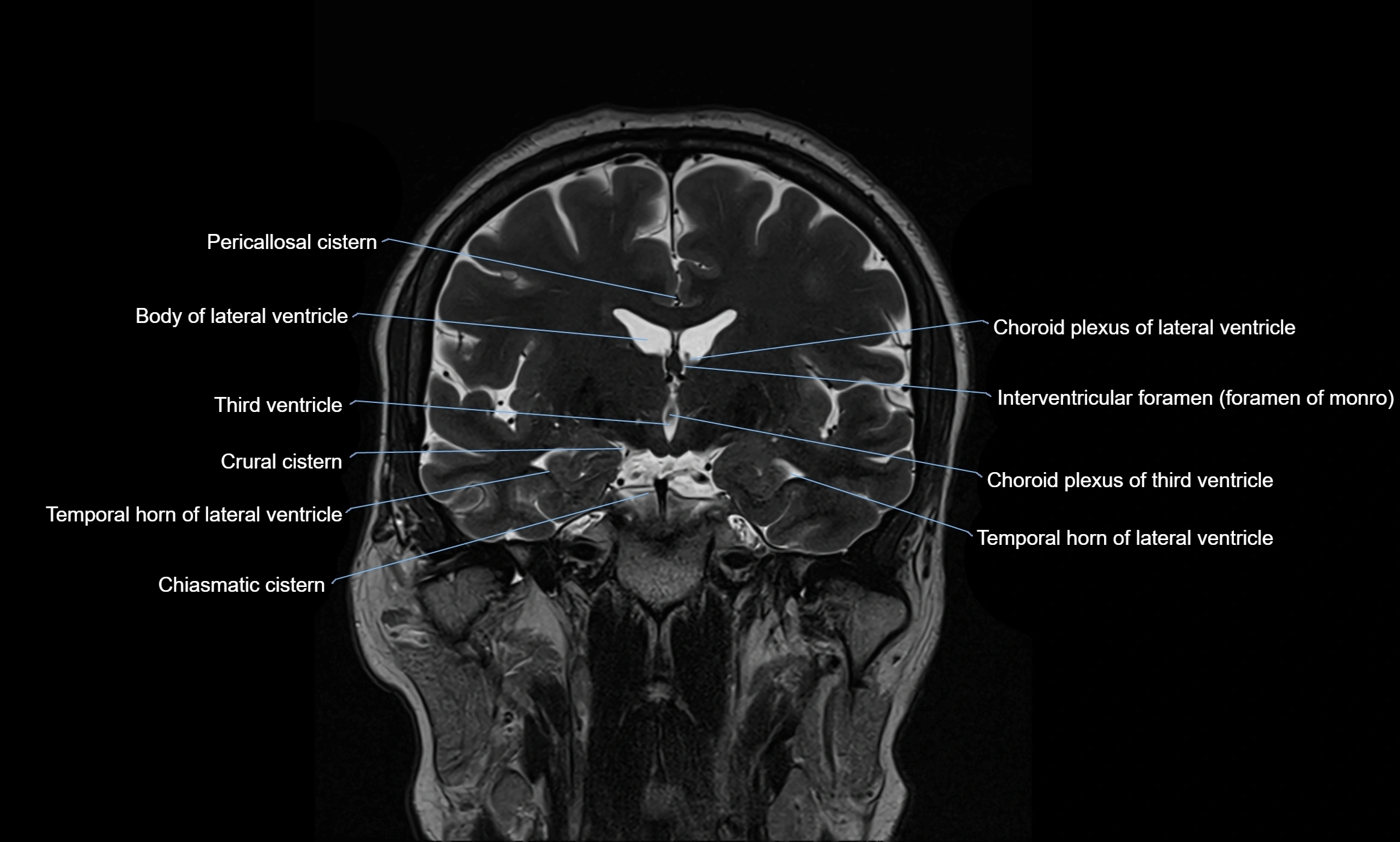 Brain cisterns  and ventricles coronal anatomy 3T MRI image-img-00001-00027.webp